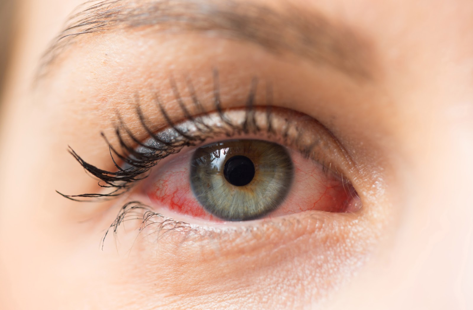 A woman with untreated red eye